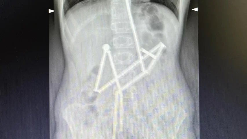 A child swallowed 20 magnets that remained connected through different parts of the stomach and intestinal tract. Doctors managed to grab the first magnet and pull it out along with a chain of 18 elements. Surgeons had to remove last one. Photos courtesy of Okhmatdyt Children's Hospital, Kyiv, Ukraine.