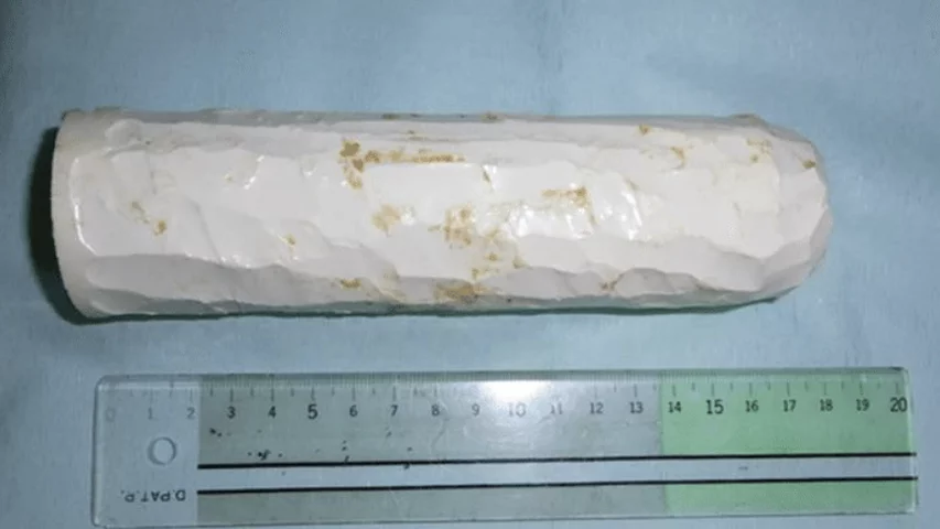Case from Japan. The silicone foreign body, made by the patient himself, who inserted it into their rectum and could not retrieve it. The item after it was removed by manual extraction measured 18 x 4 cm. Images courtesy of Case Reports in Gastroenterology