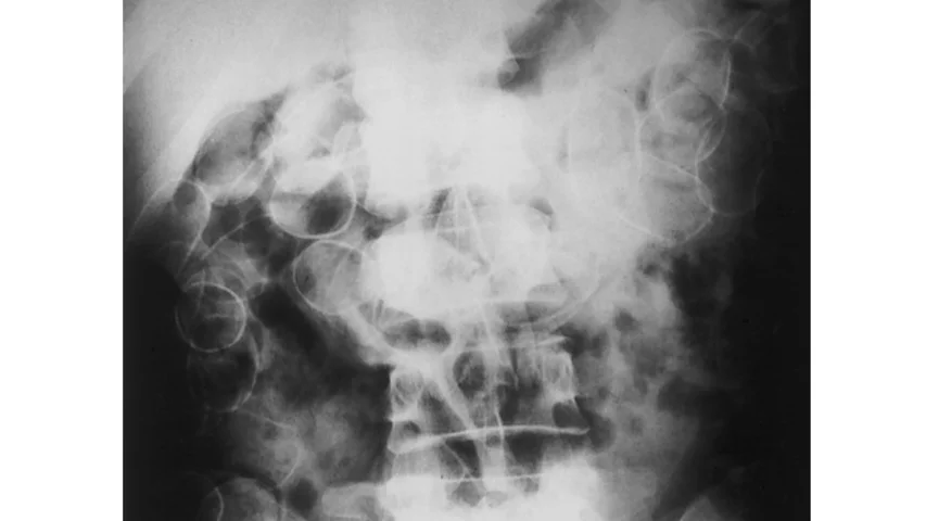 Radiograph of an adult smuggling drugs shows relatively opaque packets in the transverse and descending colon. Image courtesy of RSNA