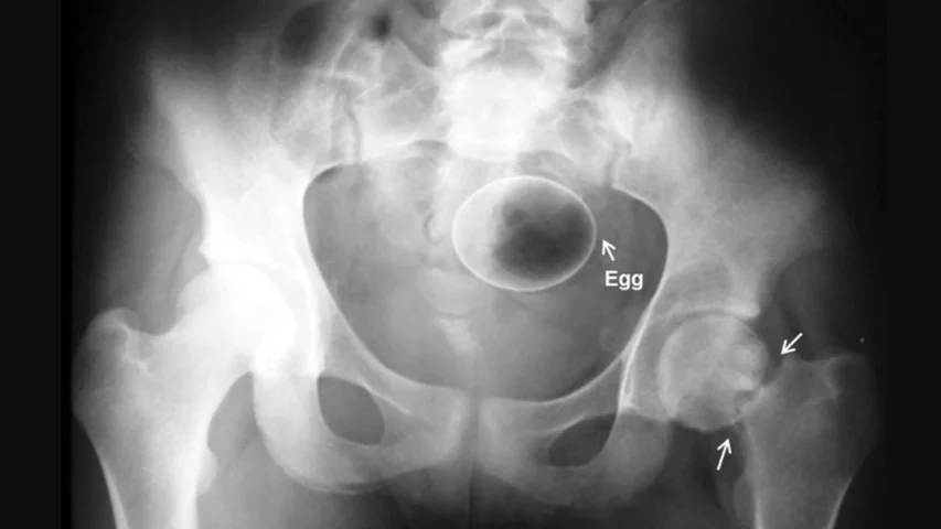 An egg inserted into the rectum. Image courtesy of Radiopaedia