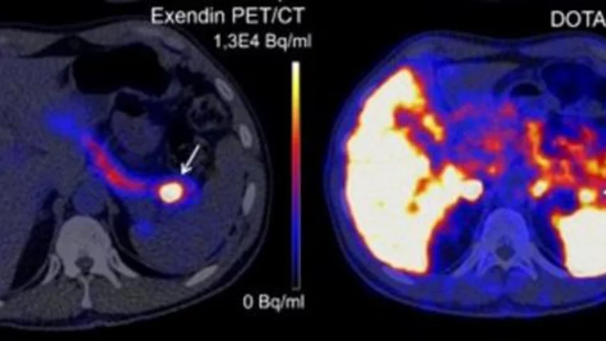 Insulinomas detected on Exendin-PET imaging.