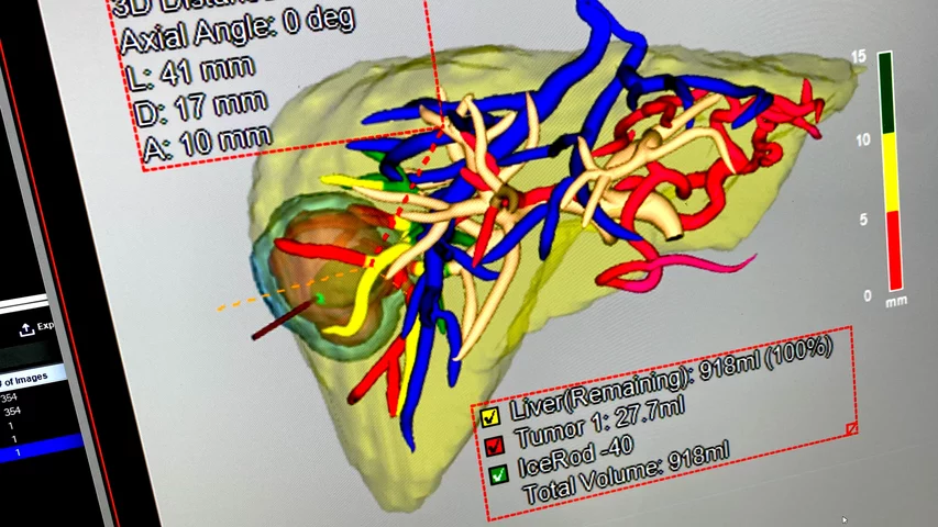 AI contouring and labeling of major vessels in liver and the cancer TeraRecon RSNA 2024. Photo by Dave Fornell
