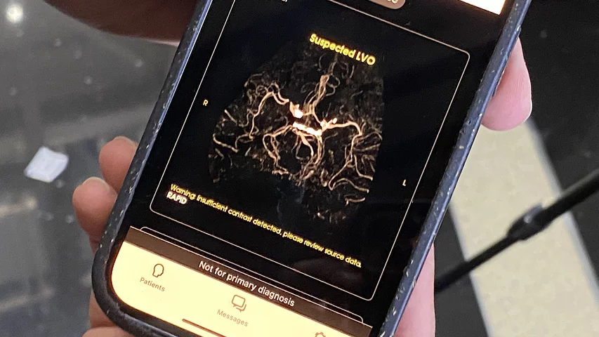 Rapid AI detection of stroke alert on smart phone, shown by a neuro-radiologist end-user from Johns Hopkins. The alerts sent by the AI right off the scanner can reduce times to tPA administration, or lead to earlier activation of the neuro-interventional lab to perform a thrombectomy Photo by Dave Fornell