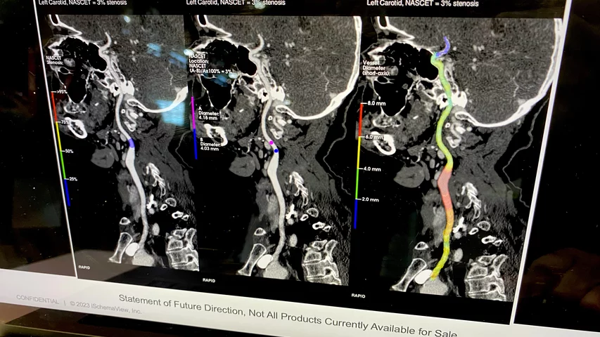 Rapid AI workflow solution for stroke imaging head and neck carotid artery CT RSNA 2024. Artificial intelligence automated to speed stoke evaluation workflow shown by Rapid AI.