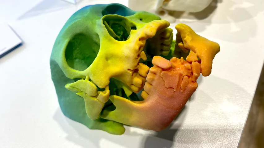 Trauma to skull and jaw CT 3D printed stratasys RSNA 2024.