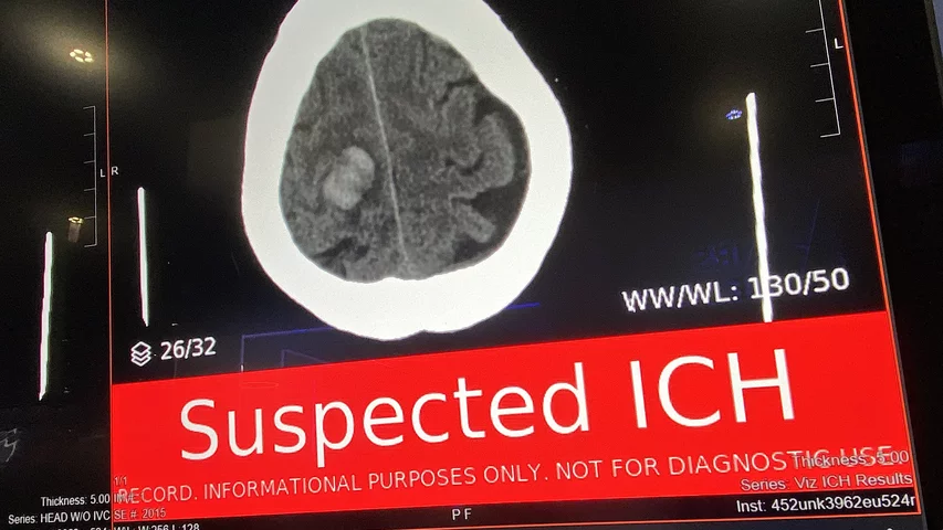 Viz.AI stroke AI detection algorithm detected ICH shown at RSNA 2024. Photo by Dave Fornell