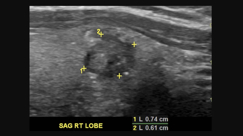 There has been criticism of the American College of Radiology (ACR) TI-RADS reporting criteria because it may be inadequate for younger populations, as a high percentage of cancers would be missed when looking at pediatric thyroid nodules. This is an example of a 13-year-old girl with subcentimeter papillary cancer appearing as a 0.7 cm thyroid nodule that is solid and hypoechoic, with irregular margins and echogenic foci (TR5). TI-RADS recommended follow-up, but not fine-needle aspiration biopsy because o