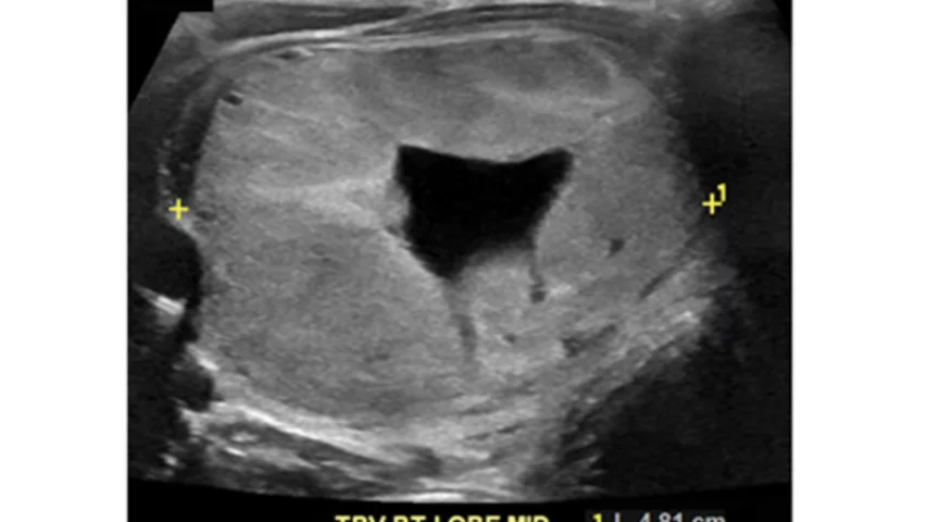 There has been criticism of the American College of Radiology (ACR) TI-RADS reporting criteria because it may be inadequate and a high percentage of cancers would be missed when looking at pediatric thyroid nodules. This example shows a 16-year-old with a thyroid follicular carcinoma on ultrasound. The 4.8 cm isoechoic, smooth nodule with no echogenic foci would be a TI-RADS 2, which under the reporting criteria recommends no followup. Image courtesy of RSNA