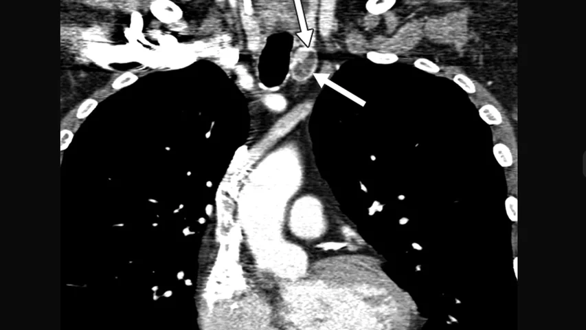 Incidental contrast-enhanced CT image of thyroid nodule in a 62-year-old man with history of lymphoma involving parotid gland. CT was ordered to evaluate for other sites of disease. Nodule is 1.9 cm (arrows) in left thyroid lobe. AJR photo