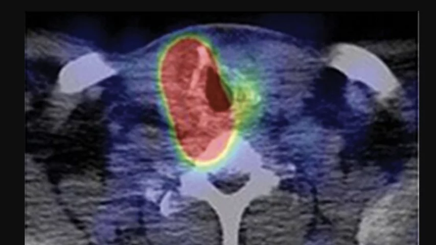 SPECT/CT fusion images show radioactive iodine accumulation in the residual thyroid remnant of thyroid papillary carcinoma in a 58-year-old man six days after administration of 4.52 GBq radioactive Iodine-131 sodium iodide. RSNA image