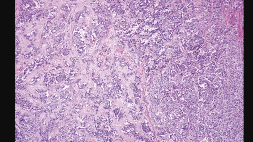 Pathology microscope image of biopsy showing medullary thyroid carcinoma in a 12-year-old girl with MEN-2B and bilateral thyroid nodules. High-power photomicrograph shows nests of polygonal tumor cells embedded in a dense amyloid stroma, with focal calcification. (Hematoxylin-eosin [H-E] stain; original magnification, x100). RSNA image