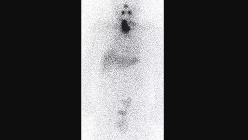 Whole-body SPECT scintigraphic image showing the ghostly image of the patient's faint body outline from the radiation they are emitting. The image shows thyroid papillary carcinoma in this 58-year-old man six days after administration of 4.52 GBq radioactive Iodine-131 sodium iodide. It shows up as a large black area in the neck. The thyroid has an affinity for iodine, so radioactive iodine is often used to treat the organ. RSNA image