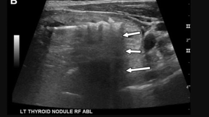 Ultrasound shows RF ablation of the left lobe nodule, commencing in the superficial portion of the gland with significant shadowing deep to the ablation site (arrows), which illustrates why the deeper portions are ablated first. This necessitated a delay in further treatment until the gas disappeared. In a 42-year-old woman with multinodular goiter producing compressive symptoms. Image courtesy of RSNA