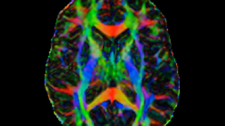 An example of MRI diffusion tensor imaging (DTI) to characterize microstructural changes. The imaging method shows the pathways of neurons in the brain to help diagnose disease or show if treatments are effective.