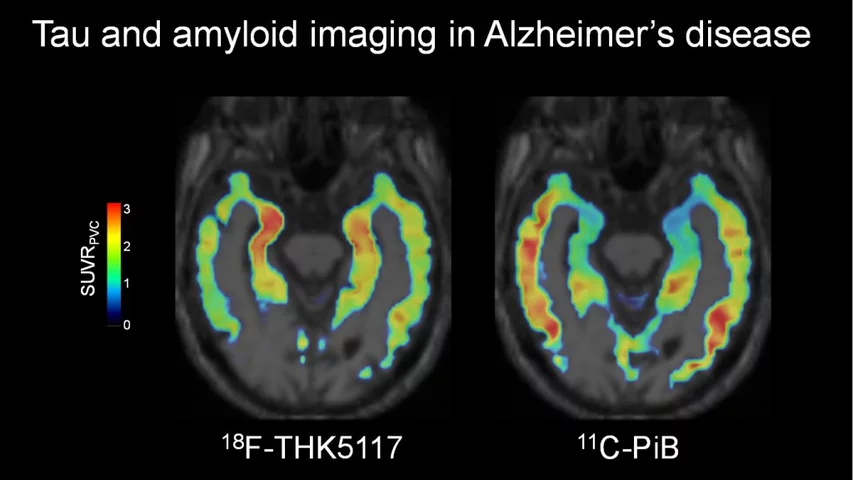Visualization of the spatial distribution of neurofibrillary tangles in Alzheimer's disease in the brain using F-18 THK-5117 PET and C-11 PiB PET scans. Both radio tracers are highly selective for tau imaging. Alzheimers imaging is more common now than several years ago because drug treatments are now available. Before imaging techniques were developed, the only definitive diagnosis of Alzheimer's was from brain biopsies.