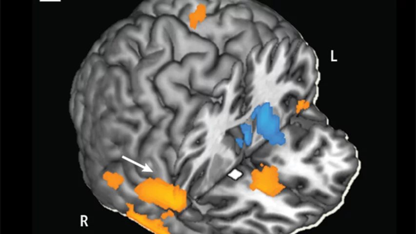 Functional MRI (fMRI) image measuring the strength of connectivity in particular brain circuits before and after subjects were given either a 20-milligram oral dose of methylphenidate used to treat ADHD or a placebo. The scans showed that methylphenidate strengthened connectivity between several brain regions involved in regulating emotions and exerting control over behaviors. Image courtesy of Brookhaven, Stony Brook, and the National Institutes of Health.