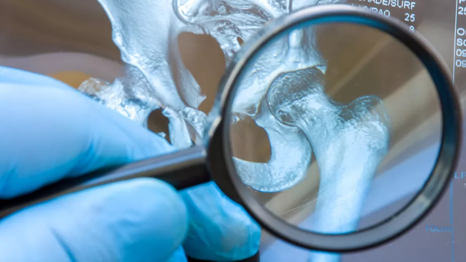 hip dysplasia joint socket