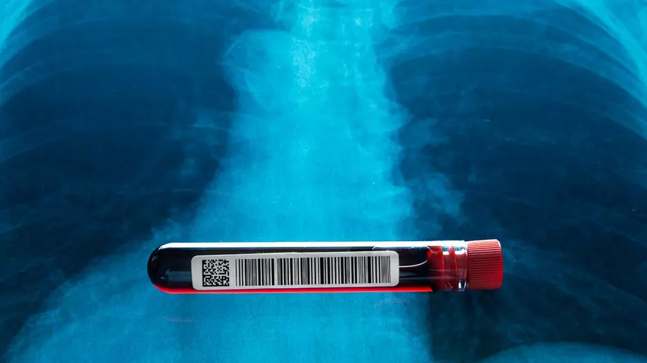 blood test lung cancer