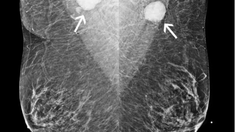 breast COVID-19 vaccination