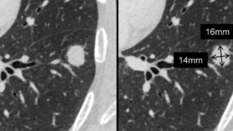 CT scan showing lung cancer nodules with measurements of each nodule to track growth or regression from treatment. Image courtesy of RSNA