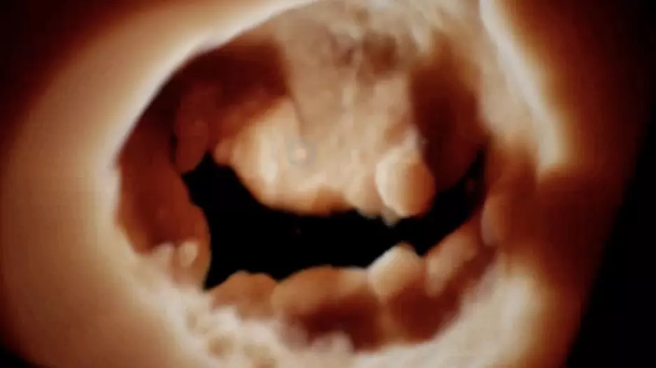 The mitral valve seen on 3D cardiac ultrasound offers a noninvasive surgeon's view of the valve for better diagnostics and pre-planning of structural heart procedures. Example from the GE Vivid E95 FlexiLight photo-realistic 3D/4D lighting system.
