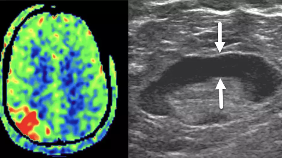 Two top stories radiology this past month was the nuclear imaging isotope shortage and an ultrasound imaging study of COVID vaccine adenopathy.