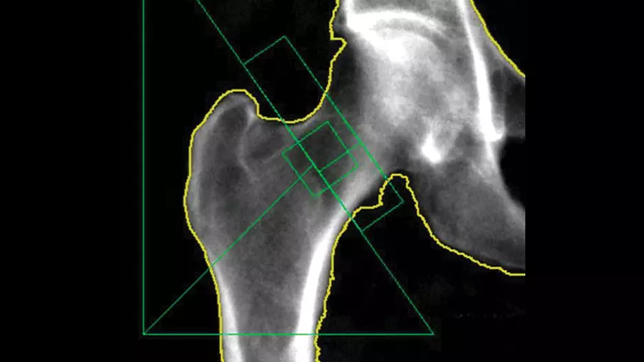 An example of dual-energy X-ray absorptiometry (DXA) imaging. Image courtesy of RSNA