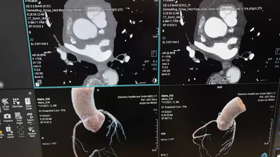 The American Society fo Nuclear Cardiology (ASNC) did not support the 2021 Chest Pain Guidelines because of the high support for cardiac CT and FFR-CT.