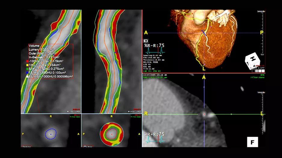 An example of CT imaging coronary plaque assessment on TeraRecon's advanced visualization software.