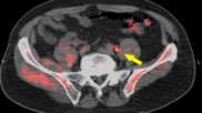 prostate cancer PET/CT