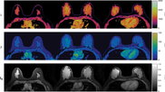 MR fingerprinting breast imaging