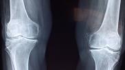 knee x-ray