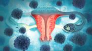 ovaries ovarian cancer