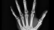 hand x-ray radiograph