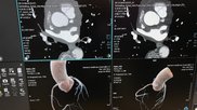 The American Society fo Nuclear Cardiology (ASNC) did not support the 2021 Chest Pain Guidelines because of the high support for cardiac CT and FFR-CT.