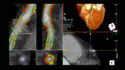 An example of CT imaging coronary plaque assessment on TeraRecon's advanced visualization software.