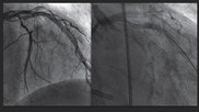 A comparison between a traditional iodine contrast angiogram (left), and a gadolinium contrast angiogram (right). MRI gadolinium contrast is starting to be used in some interventional radiology procedures and is being considered in interventional cardiology due to the iodine contrast shortage.