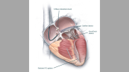 Illustration showing four innovative heart failure technologies: The V-Wave interaterial shunt to relieve pressures between the left and right sides of the heart; the Carillon Transcatheter mitral valve annuloplasty system; the Revivent TC system and the AccuCinch device. Interventional cardiology heart failure cleveland clinic 