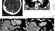 RSNA, post AZ covid vax thrombosis