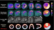 SNMMI Image of the Year 68Ga-FAPI-46 PET/CT heart attack acute myocardial infarction