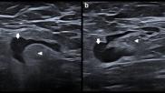 differentiating between malignant and vaccine-related lymphadenopathy