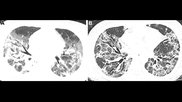 Patient with severe, lung damage from COVID. Images in a 54-year-old man with COVID-19–related acute respiratory distress syndrome and subsequent fibrosis. (A) Axial CT 2 weeks after admission shows diffuse ground-glass opacity (GGO) with reticular abnormality and traction bronchiectasis in right middle lobe, indicating organizing phase of lung injury. (B) Axial CT 6 months after admission shows decreased GGO but extensive traction bronchiectasis and architectural distortion, suggesting fibrosis. RSNA
