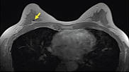 Breast MRI example showing a signal void in right breast (arrow) caused by biopsy on an axial contrast-enhanced in-phase Dixon image. It shows a signal void in right breast (arrow), which corresponded with a MammoMark/CorMark Bread Tie biopsy clip. Image courtesy of AJR.