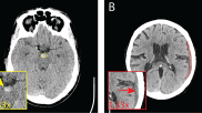 Cureus, ICH on CT