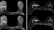 synthetic contrast-enhanced breast MRI