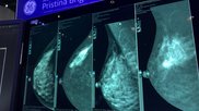 An example of contrast enhanced mammography at RSNA 2022. It shows the original mammograms to the left, and the contrast enhanced breast imaging on the right. The contrast helps enhance areas of high vascular activity, which is typical in cancer growths. Photo by Dave Fornell