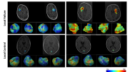 York University researchers demonstrate how AI can help predict brain metastasis outcomes