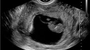 Transvaginal ultrasound of a fetus in early development during the first trimester. Image courtesy of RSNA