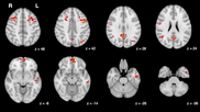 functional MRI brain scan