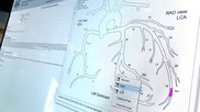 Example of a cardiovascular information system (CVIS) cath lab reporting module with a coronary tree model that will auto complete sections of the report based on how the cardiologist modifies the model. Image from the ScImage booth at ACC 2022. Photo by Dave Fornell